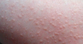 Bệnh nổi mề đay có lây không? Bệnh có di truyền không?